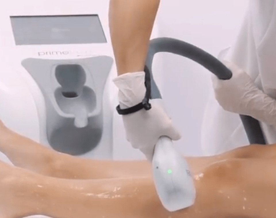 Zabieg głowicą lasera Primelase Excellence, w tle urządzenie